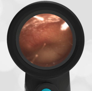 Acute Otitis Media AOM in 10 month old image on Wispr Digital Otoscope