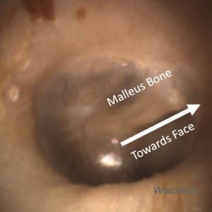 Malleus Bone towards face 