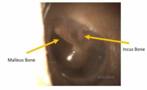 WiscMed Wispr bones of the middle ear malleus incus