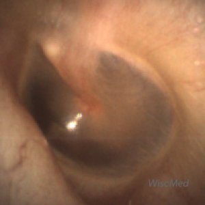 wispr digital otoscope ear image