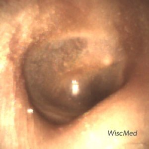wispr digital otoscope image with significant wax