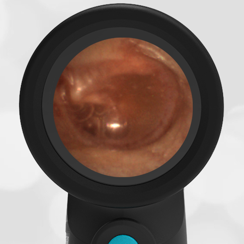 Wispr Digital Otoscope by WiscMed showing image of otitis media with effusion OME in 7 year old