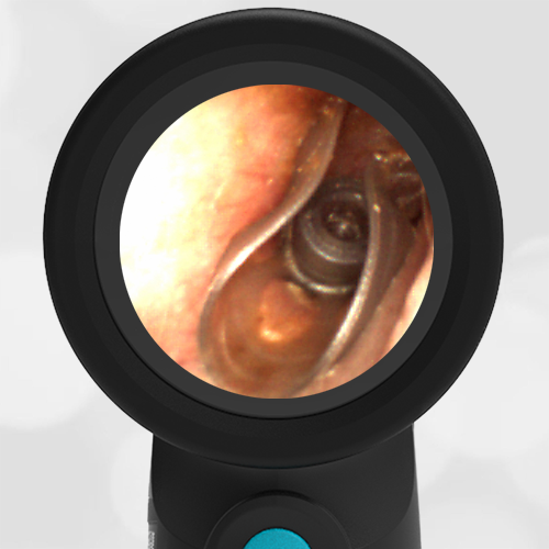 Wispr Digital Otoscope showing image of hearing aid tip