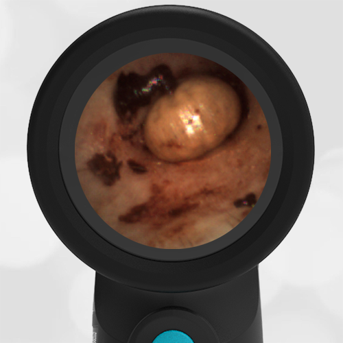 Wispr Digital Otoscope showing image of tick in ear canal