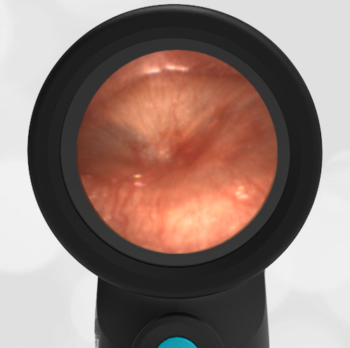 Wispr Digital Otoscope by WiscMed showing ear exam image of Acute Otitis Media AOM by Dr. Daniel Ostrovsky