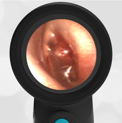 Wispr Digital Otoscope by WiscMed showing ear exam image of Bullous Myringitis by Dr. Daniel Ostrovsky
