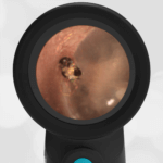 Wispr Digital Otoscope by WiscMed showing ear exam image of spider by Dr. Daniel Ostrovsky