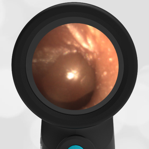 Wispr Digital Otoscope by WiscMed showing ear exam image of Bullous Myringitis by Dr. Andrew Schuman